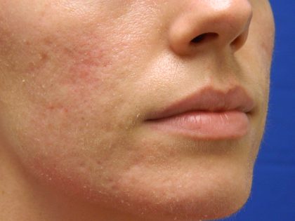 Acne Scarring Before & After Patient #9483
