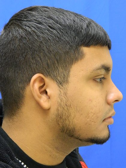 Acne Scarring Before & After Patient #9479