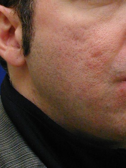 Acne Scarring Before & After Patient #9484