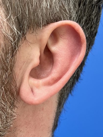 Earlobe Repair Before & After Patient #9537
