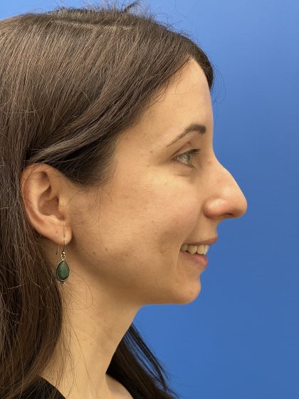 Rhinoplasty Before & After Patient #9544