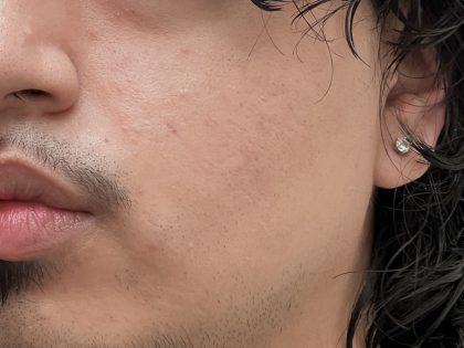 Acne Scarring Before & After Patient #9481