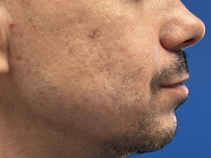 Acne Scarring Before & After Patient #9480