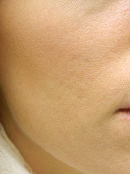 Acne Scarring Before & After Patient #9482