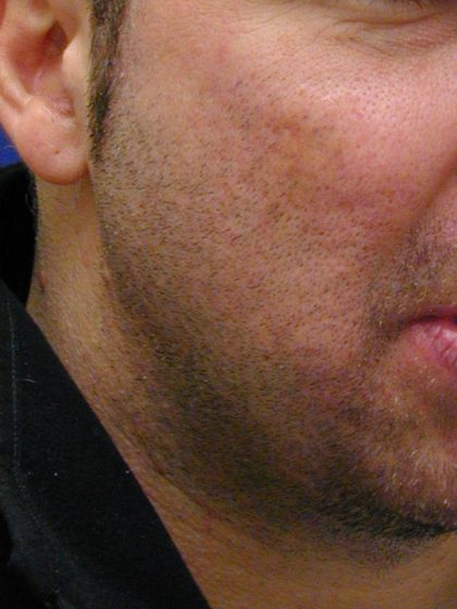 Acne Scarring Before & After Patient #9484