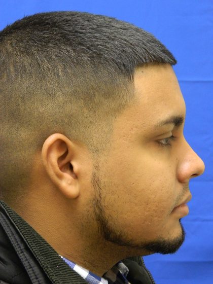 Acne Scarring Before & After Patient #9479