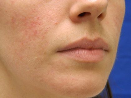 Acne Scarring Before & After Patient #9483
