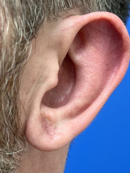Earlobe Repair Before & After Patient #9537