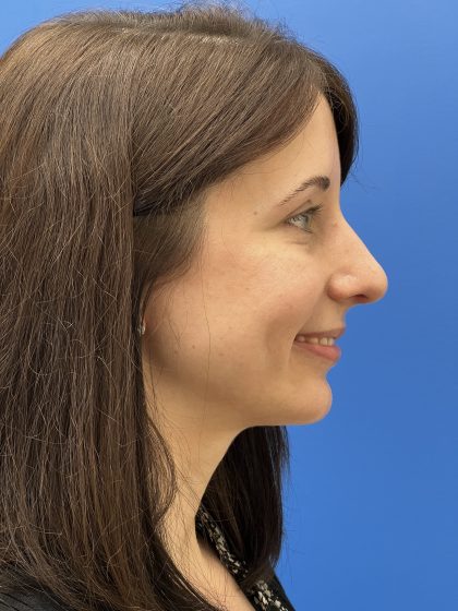 Rhinoplasty Before & After Patient #9544