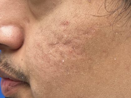 Acne Scarring Before & After Patient #9481