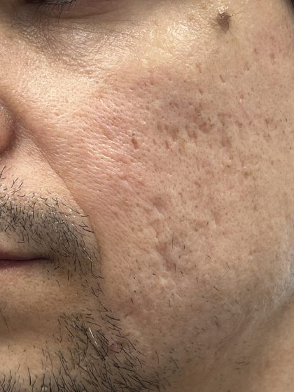 Acne Scarring Before & After Patient #9480