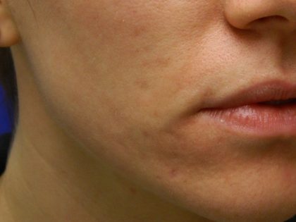 Acne Scarring Before & After Patient #9482