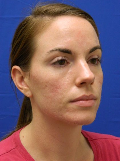 Acne Scarring Before & After Patient #9483