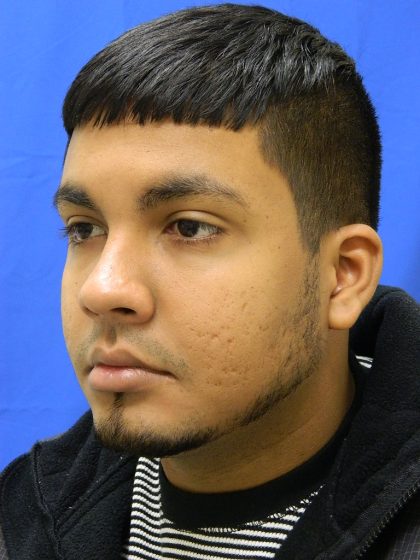 Acne Scarring Before & After Patient #9479