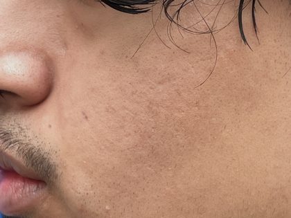 Acne Scarring Before & After Patient #9481