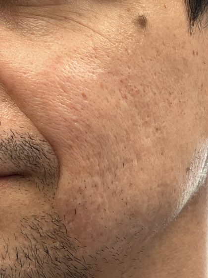 Acne Scarring Before & After Patient #9480