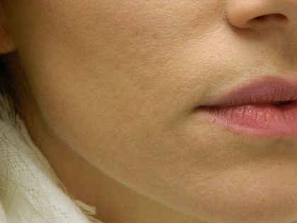 Acne Scarring Before & After Patient #9482