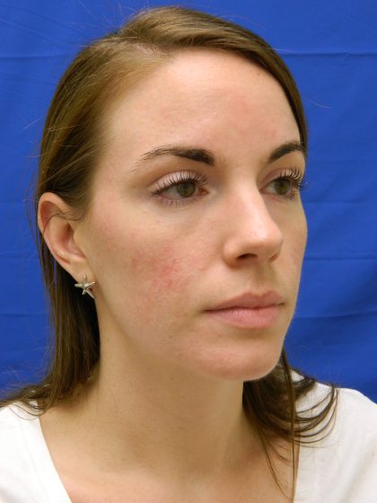 Acne Scarring Before & After Patient #9483