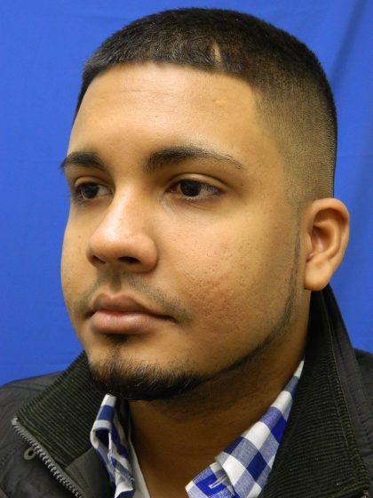 Acne Scarring Before & After Patient #9479