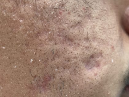 Acne Scarring Before & After Patient #9481