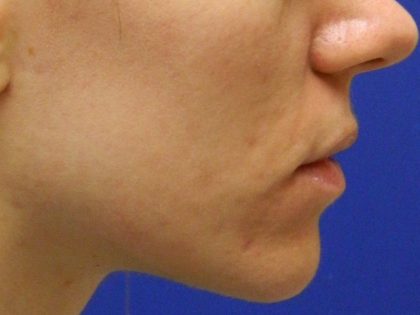 Acne Scarring Before & After Patient #9482