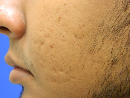 Acne Scarring Before & After Patient #9479