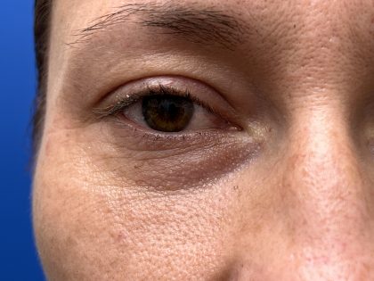 Lower Blepharoplasty Before & After Patient #9555