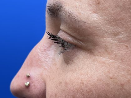 Lower Blepharoplasty Before & After Patient #9555