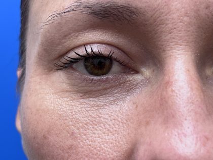 Lower Blepharoplasty Before & After Patient #9555