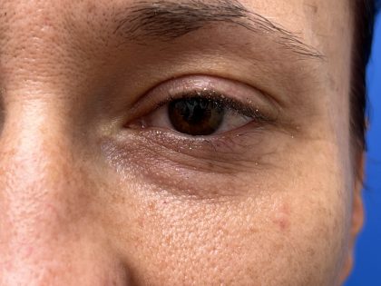 Lower Blepharoplasty Before & After Patient #9555