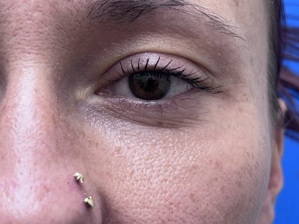 Lower Blepharoplasty Before & After Patient #9555