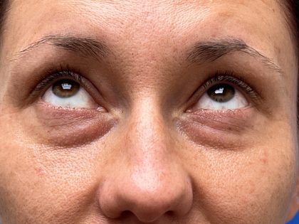 Lower Blepharoplasty Before & After Patient #9555