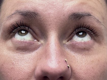 Lower Blepharoplasty Before & After Patient #9555